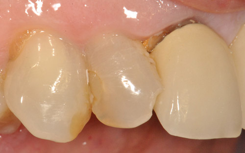PROTESI dentale prima e dopo