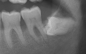 Estrazione dell'ottavo dente varese
