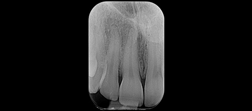 estetica mucogengivale - rx pre operatoria | studio dentistico dr. Dino Azzalin
