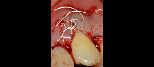 parodontologia rigenerazione prima e dopo