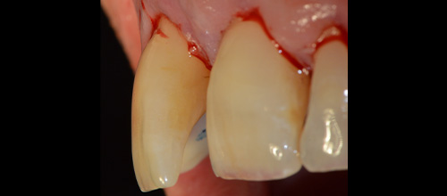 parodontologia correzione difetto osseo e riposizionamento chirurgico