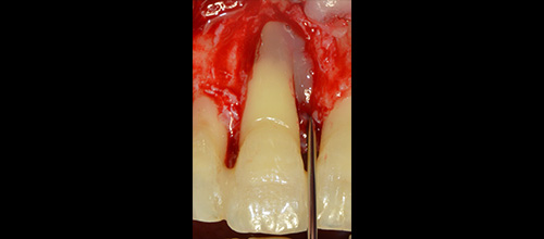 parodontologia correzione difetto osseo e riposizionamento chirurgico studio dentistico dr. Azzalin varese