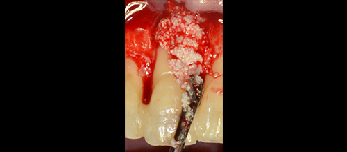 rparodontologia correzione difetto osseo e riposizionamento chirurgico studio dentistico dr. Azzalin varese