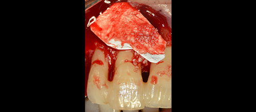 parodontologia correzione difetto osseo e riposizionamento chirurgico