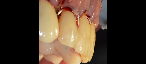 parodontologia correzione difetto osseo e riposizionamento chirurgico studio dentistico dr. Azzalin varese