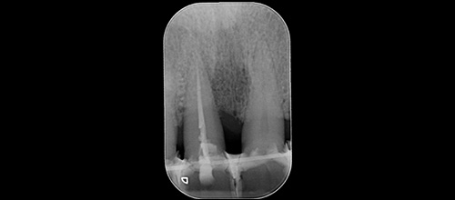 parodontologia correzione difetto osseo e riposizionamento chirurgico 